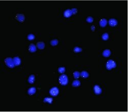 Positive result from the test for ALK gene rearrangement. Blue=chromosomes, bright spots=places on chromosome where fluorescent probe binds.