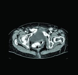 Computed tomography image of the pelvis of an ovarian cancer patient.